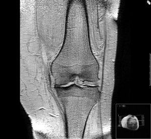 Osteoarthritis of the knee